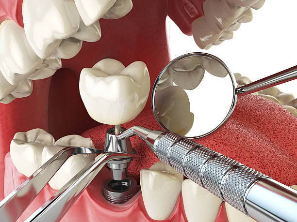 Best Emergency Dental Care for Broken or Chipped Teeth in Morenci, MI